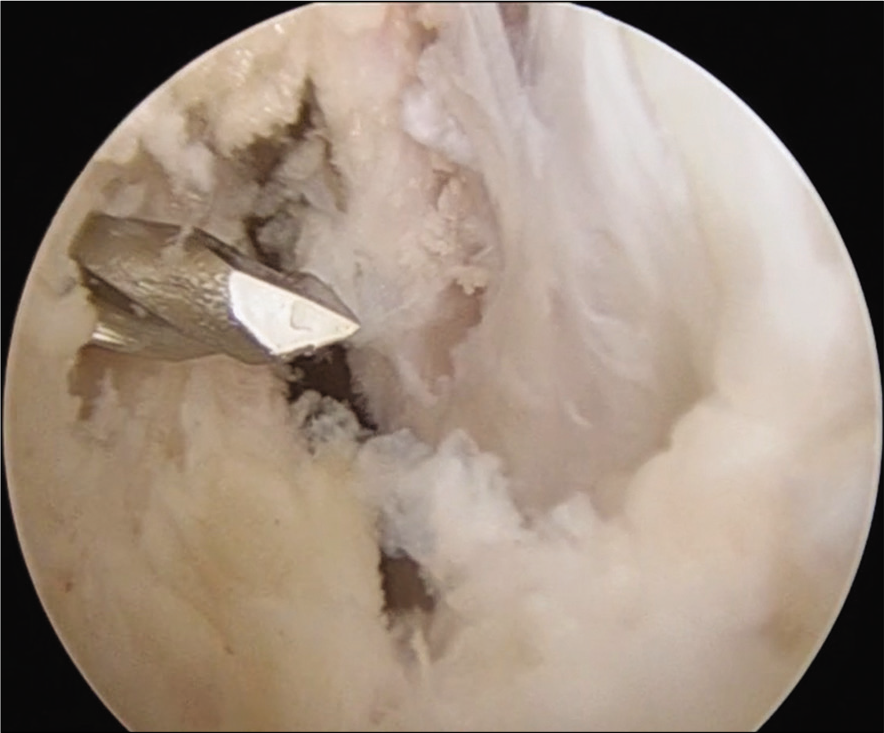 Femoral guide wire drilled correctly.