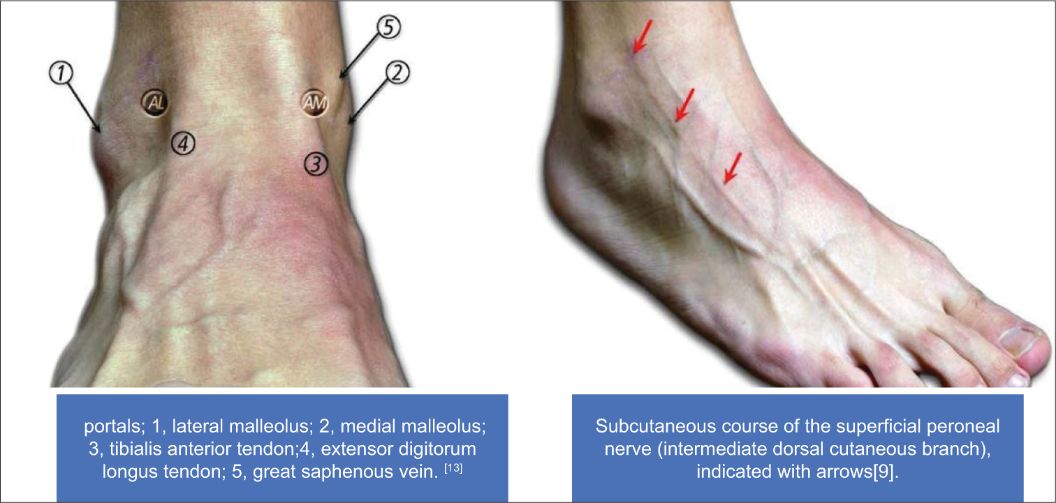 Surface anatomy of relevant landmarks in ankle arthroscopy.[13]