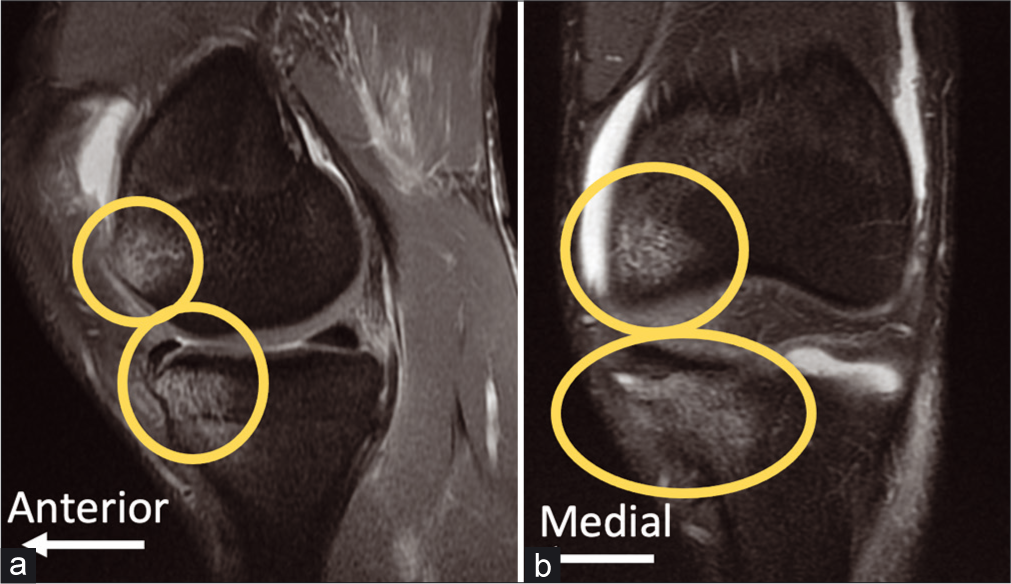 Bone Bruises in Posterolateral Corner (PLC) Injuries are commonly observed on magnetic resonance imaging (MRI), and should be taken as evidence of PLC injuries until proven otherwise. The images above are sagittal (a) and coronal (b) fat- suppressed proton-dense T2-weighted MRI views of a left knee with an isolated PLC injury. Bone bruises of the medial compartment are thought to be common in PLC injuries due to the mechanism of hyperextension, frequently with a varus component. Medial compartment tibial plateau fractures are also common in PLC injuries, both phenomenon related to varus moment causing impaction in the medial compartment.