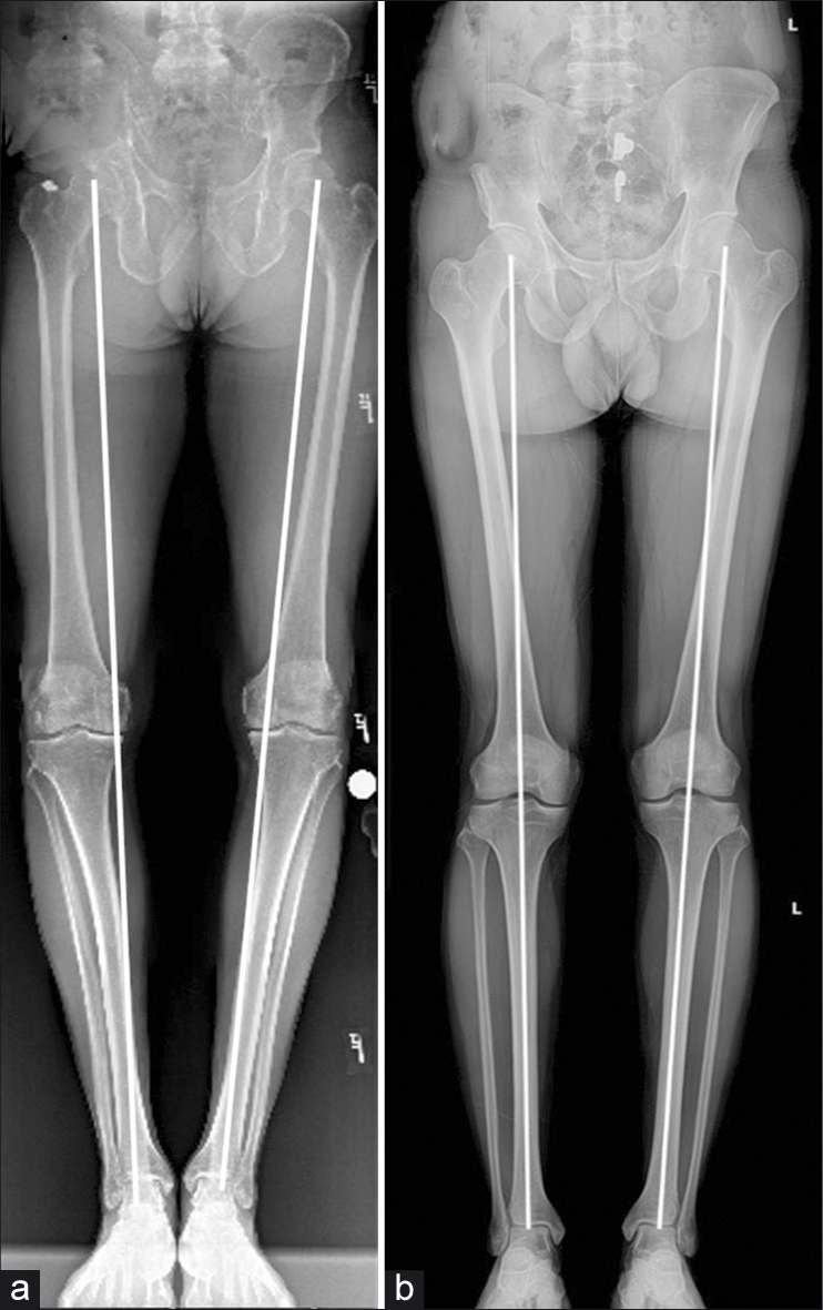 Varus Alignment (a) is not tolerated by posterolateral corner reconstruction grafts and must be addressed prior to MLKI. Alignment is determined by drawing a line from the center of the femoral head to the midpoint of the dome of the talus. If the line passes through the center of the tibial spines, the patient is in neutral alignment. (b) If the lines traverses medial to the apex of the medial tibial spine (eminence), the patient is in varus alignment. Opening- wedge proximal tibial osteotomy is often chosen to address this deformity, and is one case where multiple ligament reconstructions of the knee should be staged.