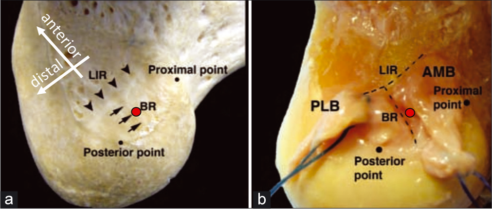 The Lateral Intercondylar Notch contains the attachments of the anteromedial and posterolateral bundles of the anterior cruciate ligament. The lateral intercondylar ridge (LIR), also known as residents’ ridge, serves as the anterior-most extent of the ACL. (a) The bifurcate ridge (BR) travels from the posterior cartilage margin to the mid-point of the LIR, and separates the ACL bundles. The overall anatomic center of the ACL is indicated with a red circle above; this is the ideal location for the femoral ACL reconstruction tunnel. It is slightly proximal to the BR, and should be as posterior as possible while allowing for a 2 mm backwall after reaming the tunnel with a 10-mm reamer. (b) This image initially appeared in Ziegler CG, Pietrini SD, Westerhaus BD, Anderson CJ, Widjicks CA, Johansen S, Engebretsen L, LaPrade RF. Arthroscopically Pertinent Landmarks for Tunnel Positioning in Single-Bundle and Double-Bundle Anterior Cruciate Ligament Reconstructions. Am J Sport Med. 2011;39(4):743-751.