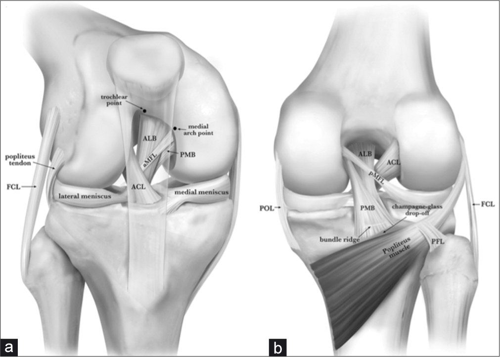 Anterior (a) and posterior (b) anatomy of the posterior cruciate ligament (PCL). Pertinent anatomy for double-bundle PCL reconstruction (db-PLCR) includes the trochlear point and medial arch point anteriorly (a). The trochlear point marks the proximal extent of the anterolateral bundle (ALB) and the medial arch point represents the distal extent of the ALB along the anterior cartilage margin. Posteriorly, the bundle ridge separates the bundles of the PCL on the PCL facet, just above a bony shelf called the champagne-glass drop-off. Reproduced with permission from Kennedy NI, Wijdicks CA, Goldsmith MT, et al. Kinematic analysis of the posterior cruciate ligament, part 1: the individual and collective function of the anterolateral and posteromedial bundles. Am J Sports Med. 2013;41(12):2828- 2838.