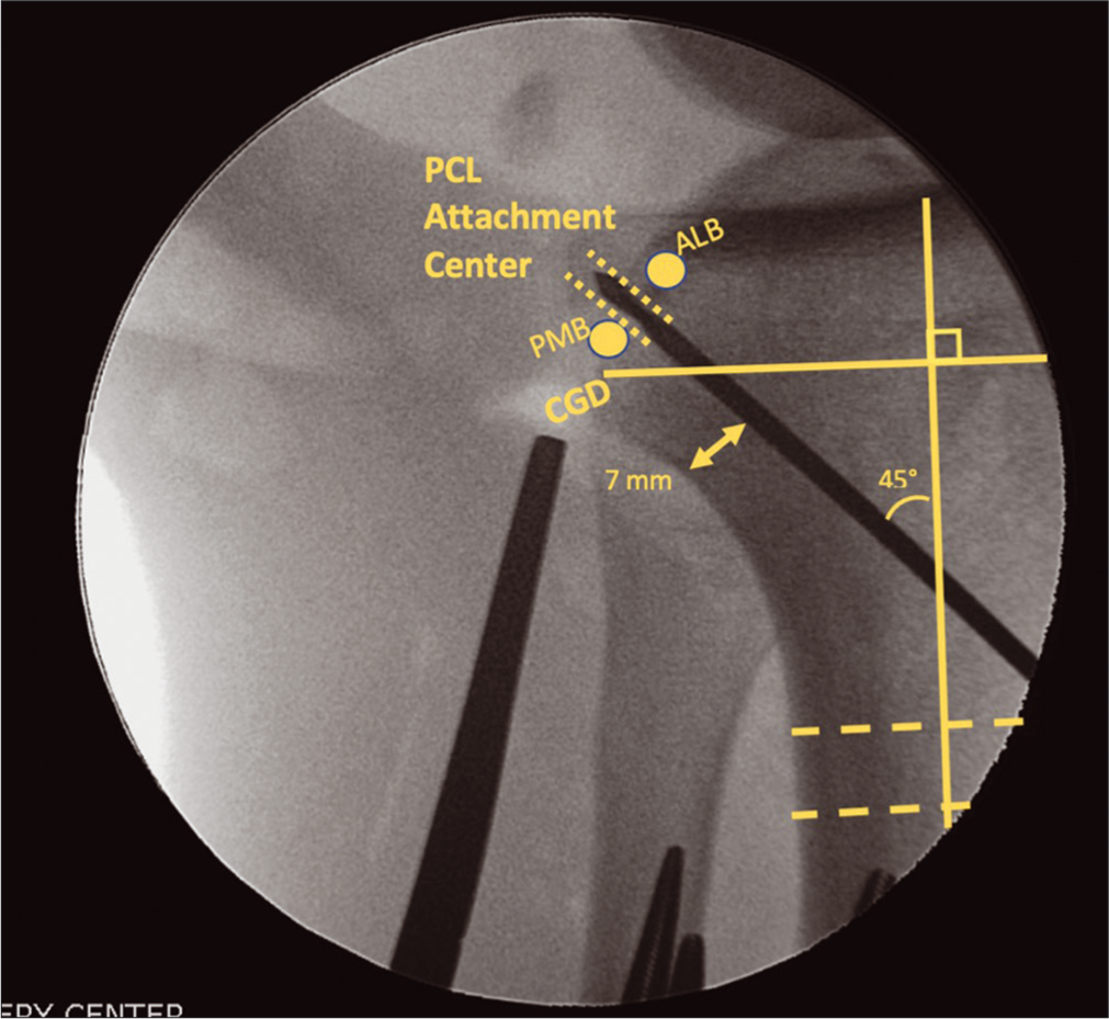 Aiming the tibial posterior cruciate ligament (PCL) tunnel to intersect with the anatomic PCL attachment center on the PCL facet requires the use of intraoperative fluoroscopy. While two grafts are used to reconstruct the PCL (ALB and AMB), only one tibial tunnel is used due to the close proximity attachment sites of the two bundles on the PCL facet. The guide pin is aimed from the anterior tibia, approximately midway between the anterior tibial crest and the medial border of the tibia. An adequate bone bridge must be maintained posteriorly (minimum 7 mm), and the pin is angles at approximately 45° relative to the long axis of the tibia (as determined above with a two line method). The pin should emerge midway between the ALB and PMB footprints, just above the champagne-glass drop-off. This figure originally appeared in Floyd ER, Carlson GB, Monson JK, and LaPrade RF. Multiple Ligament Reconstructions of the Knee and Posterolateral Corner. Arthroscopy Techniques. 2021;10(5):E1269-E1280.