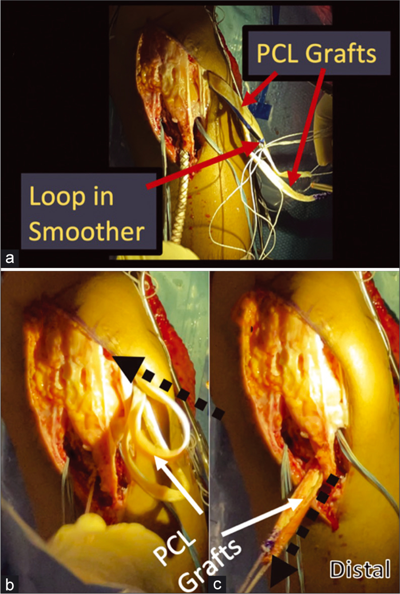 Passing the PCL grafts using a large smoothing tool. A smoother passed up through the tibial PCL tunnel is used to ease the path of graft passage and brought out through the lateral portal. Once brought out through the lateral portal, the sutures through the tubularized distal ends of the PCL grafts are passed through a loop on the proximal end of the smoother. (Panel a). The smoother is then pulled distally, pulling the distal PCL graft ends back into the joint through the lateral portal. (Panel b) The distal suture ends of the PCL grafts are pulled down the tibial tunnel as the smoother is withdrawn, and then grasped to complete passage of the PCL grafts through the PCL tibial tunnel. (Panel c). PCL: Posterior cruciate ligament.