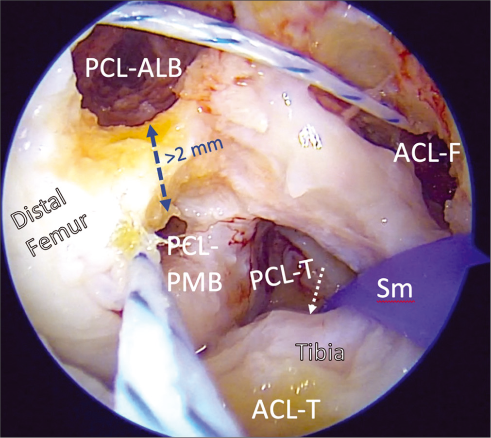 Creation of PCL and ACL femoral tunnels in the intercondylar notch is challenging, as the number of bony reconstruction tunnels needed in multiple ligament reconstructions may introduce dangers of convergence and blowout. Using arthroscopic landmarks to reconstruct the ACL and PCL anatomically and using validated orientation angles for to drill and overream guide pins is important to prevent these potential complications and restore the native biomechanics of the knee. The PCL grafts (AMB, PMB) are passed and secured in their femoral tunnels first, then will then be passed through the tibial tunnel. Then the ACL graft is passed up through its tibial tunnel and secured in the femur. PCL: Posterior cruciate ligament, ALB: Anterolateral bundle, PMB: Posteromedial bundle, ACL-F: ACL femoral tunnel, ACL-T, PCL-T: Tibial tunnels for ACL, PCL, Sm: Large smoothing tool with loop for graft passage.