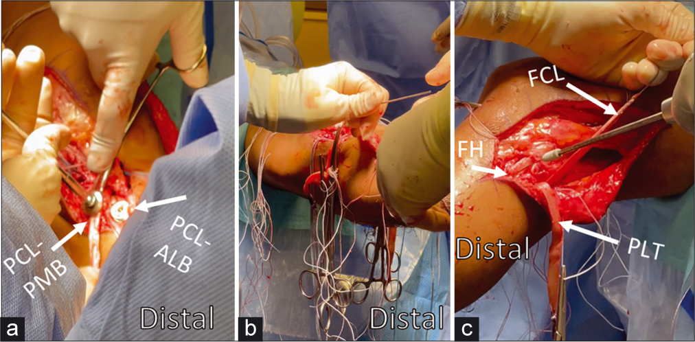 Graft passage order and positioning for fixation have been established using biomechanical models to approximate native kinematics. In vitro studies have demonstrated the PCL should be tensioned first; tensioning the ACL first leads to abnormal posterior tibial translation, and tensioning the PLC first has been observed to increase tibial internal rotation. After passage, the PCL-ALB graft is secured first at 90° of flexion with neutral rotation and an anterior reduction force to restore step-off. Then the PCL-PMB is secured in extension with a distal traction force applied to the graft (Panel a). The ACL is also secured in extension with distal traction and cycling of the knee to eliminate slack (Panel b). The FCL graft is then secured likewise with distal traction but in 20° of flexion and neutral rotation with a valgus reduction force through the fibular head (Panel c). After both split Achilles allografts (PLC) are passed posterior to anterior through the tibial tunnel, both are secured with the knee in 60° of flexion and with neutral rotation. Assessment of Lachman and range-of-motion can then be assessed to verify appropriate restraint after graft fixation. ACL: Anterior cruciate ligament, PCL: Posterior cruciate ligament, ALB: Anterolateral bundle, PMB: posteromedial bundle, FCL: Fibular collateral ligament, PLC: Posterolateral corner, FH: Fibular head, PLT: Popliteus tendon