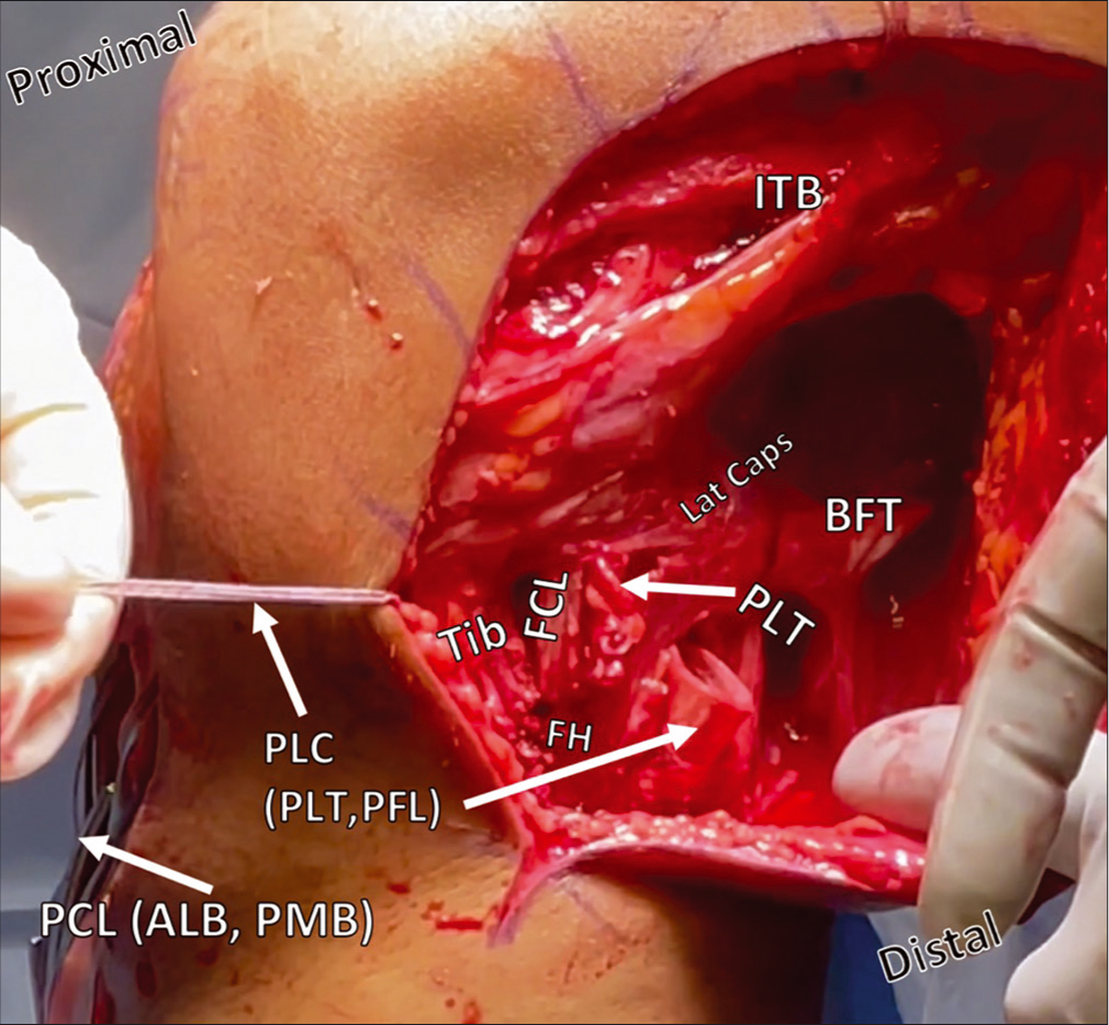 Posterolateral corner reconstruction during passage of the FCL/PFL and PLT grafts from posterior to anterior through the tibial tunnel. Restoration of the anatomy of the PLC is accomplished with two grafts to reconstruct three ligaments. Above, the FCL has been passed deep to the ITB from its proximal attachment on the femur, and, along with the PLT graft, is being pulled from posterior to anterior through a proximal tibial tunnel. Other structures, including the PCL grafts protruding from the anterior tibial cortex, and the BFT are also labelled. ITB: Iliotibial band, Lat caps: Lateral capsule, BFT: Biceps femoris tendon, PLT: Popliteus tendon, FCL: Fibular collateral ligament, FH: Fibular head, Tib: Tibia, PLC: Posterolateral corner, PCL: Posterior cruciate ligament, ALB: Anterolateral bundle, PMB: Posteromedial bundle.