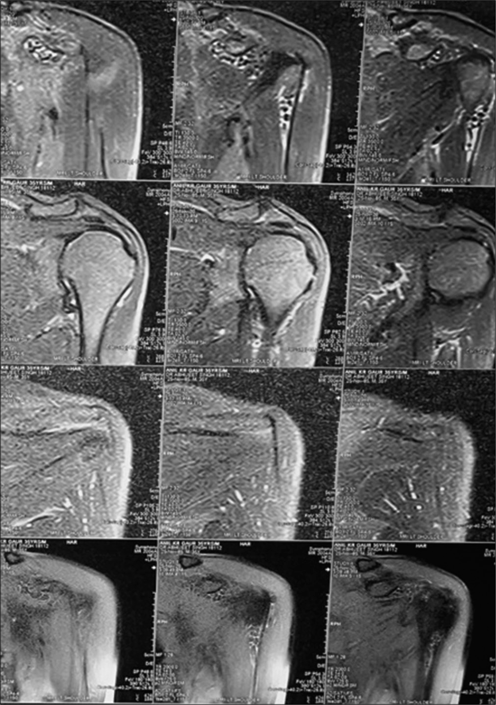 MRI of the left shoulder showing multiple loose bodies.