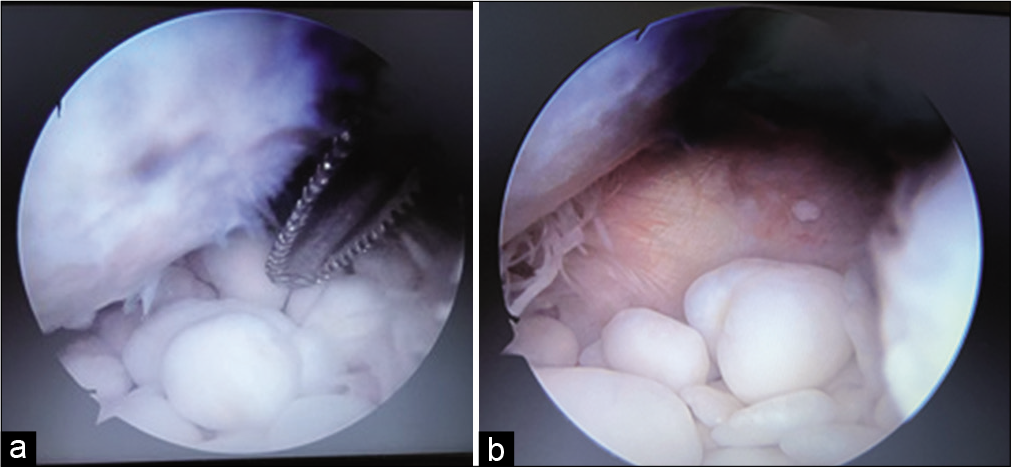 (a and b) Multiple loose bodies in the shoulder joint.