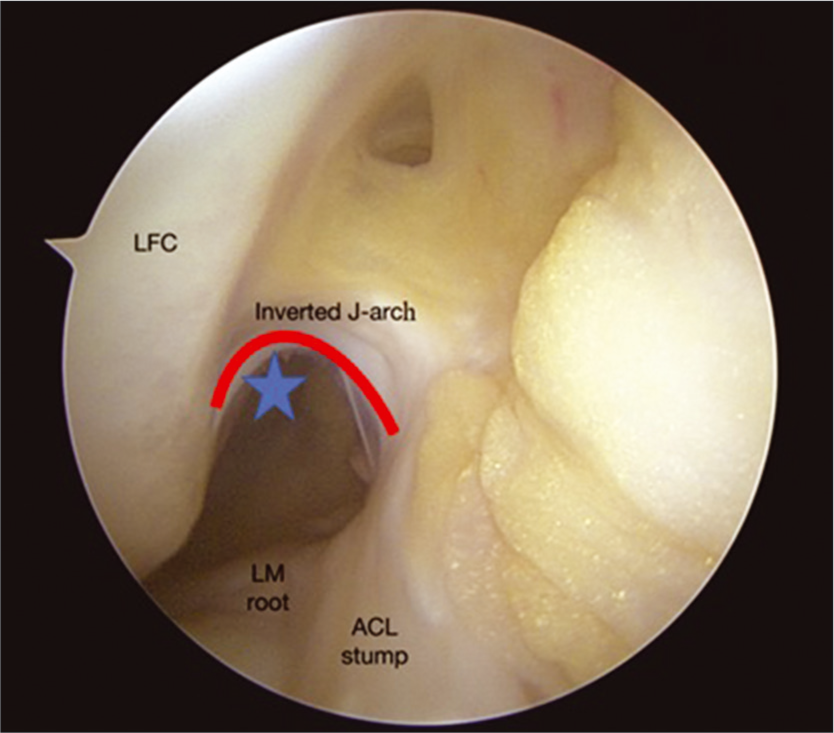 Arthroscopic view showing the J arch (red line) under which the guidewire is passed to create the femoral tunnel (star).