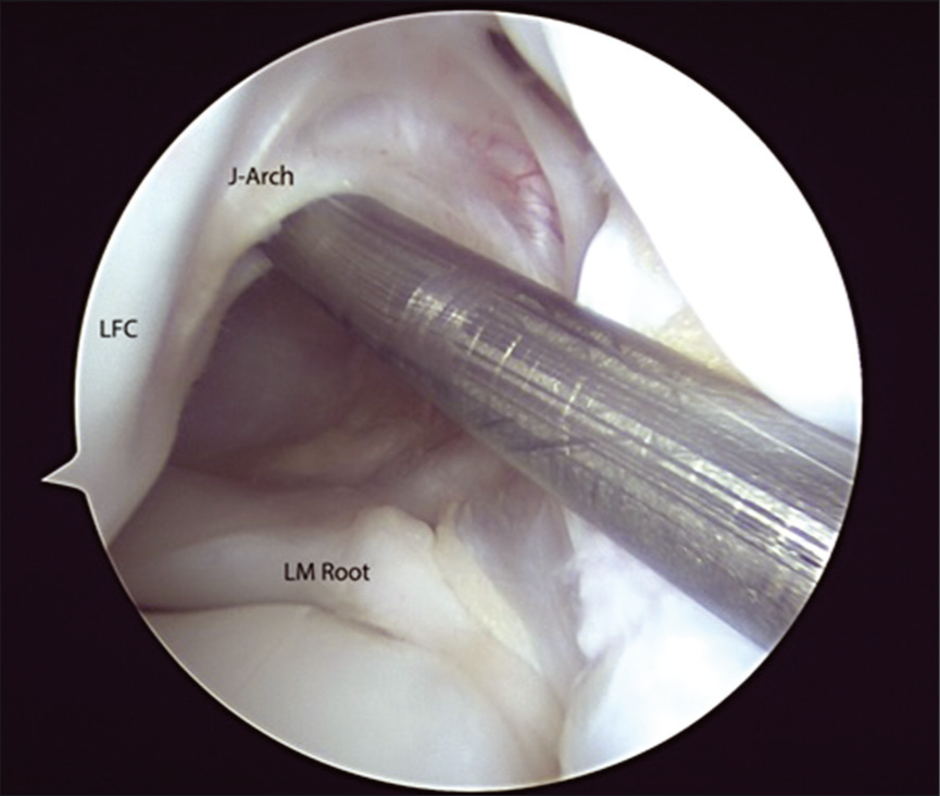 Arthroscopic view showing the passage of guidewire in the femoral tunnel under the J arch. Also seen are the root of lateral meniscus and the lateral femoral condyle.