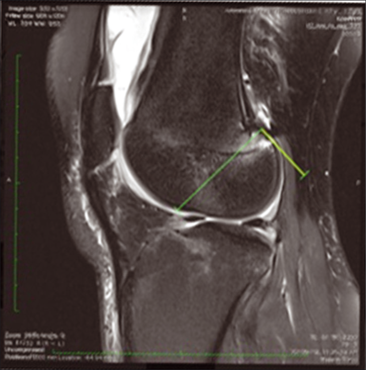 Using magnetic resonance imaging- finding femoral coordinates- aligned parallel to (x) and perpendicular to (y) (seen as green lines here) the Blumensaat’s line (the roof of the intercondylar fossa).