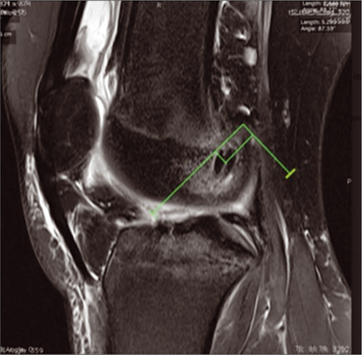 MRI with calculation of femoral coordinates, shown by the green box made between the green lines parallel and perpendicular to Blumensaat’s line.