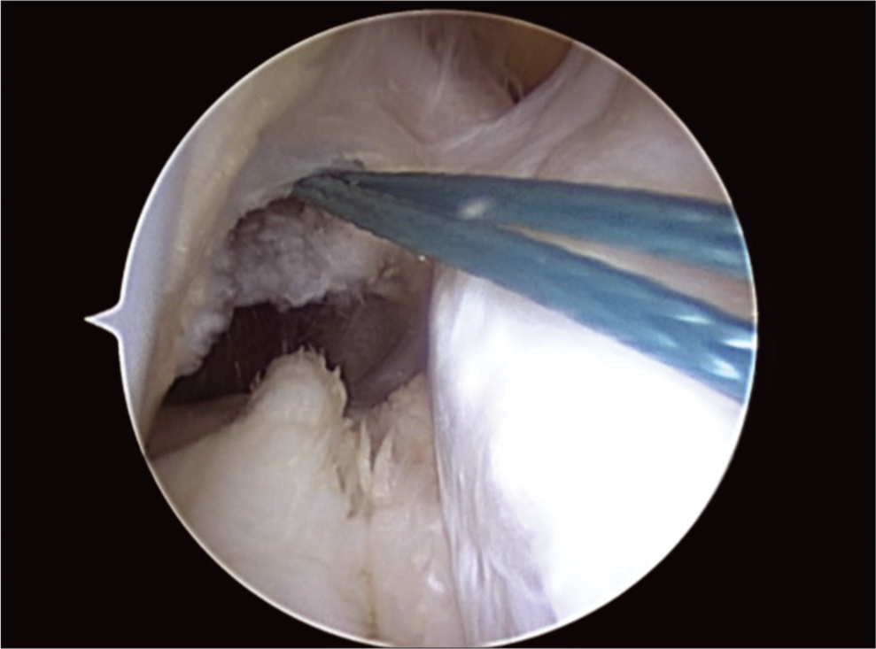 Threads passing through the femoral tunnel.