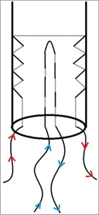 The tendon is prepared by two whip stitches, one anterior to posterior (blue) and the other from medial to lateral (red).