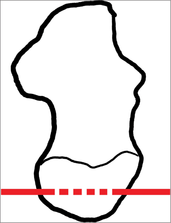 Drill holes through calcaneal tuberosity. Medial to lateral. It accommodates the stitches marked in a red dashed line.