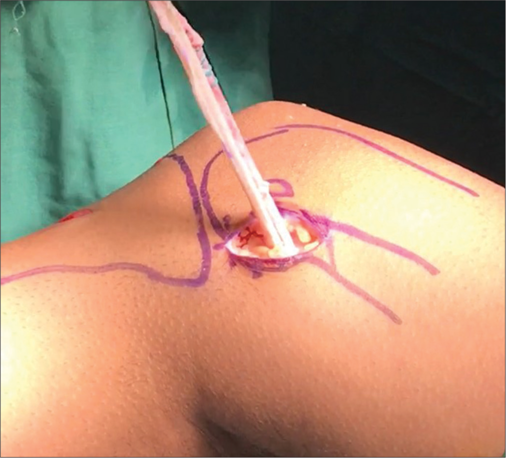 Semitendinosus graft being passed under the adductor longus tendon close to its insertion site.