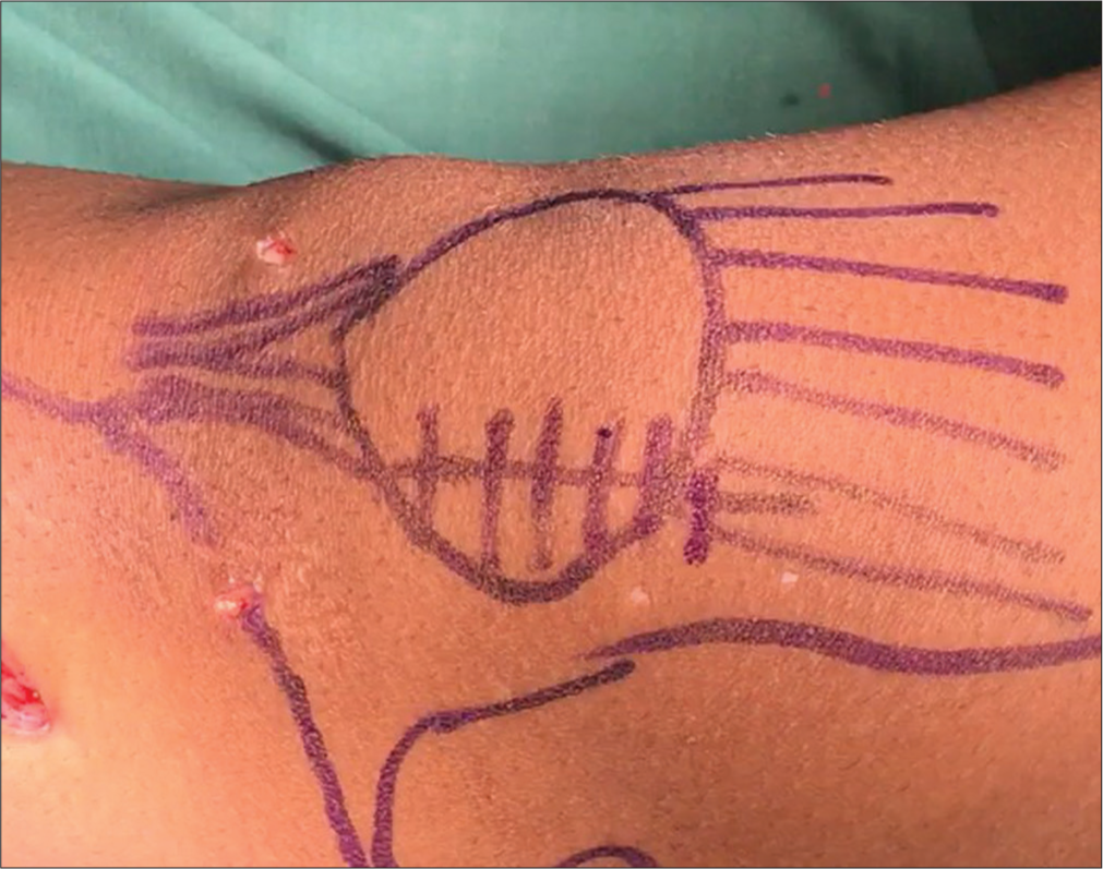 Skin marking over the patella in the midline of the knee depicting the site of the second incision.