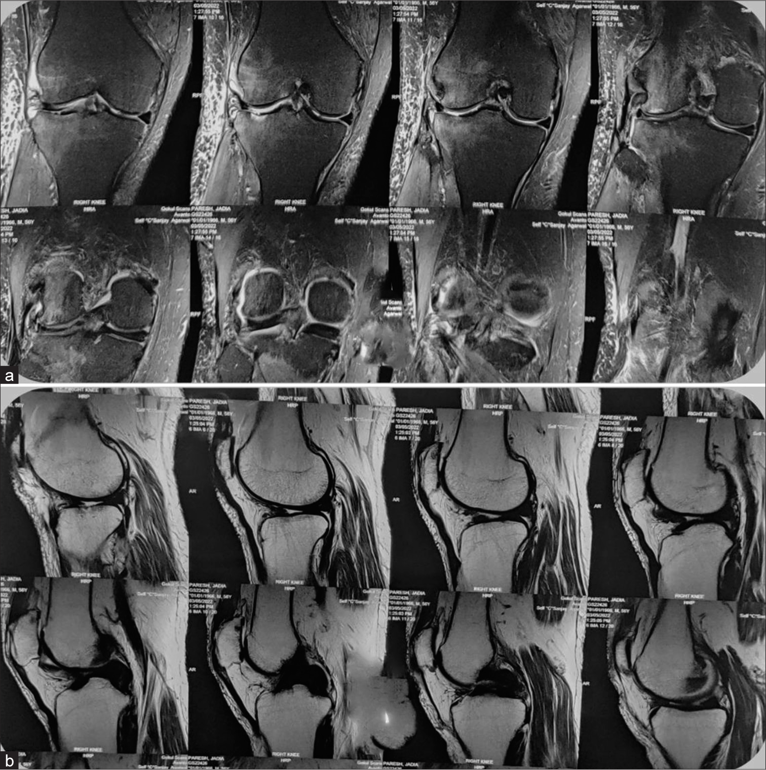 (a) Magnetic resonance imaging of coronal section showing cartilage degeneration of both compartments. (b) Sagittal section showing grade 3 complex tear of lateral meniscus with mucoid changes of cruciate.