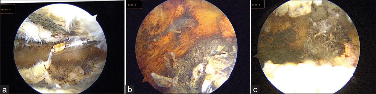 (a-c) Arthroscopic image of a knee joint showing synovial hypertrophy with blackish-brown pigmentation with loose body.