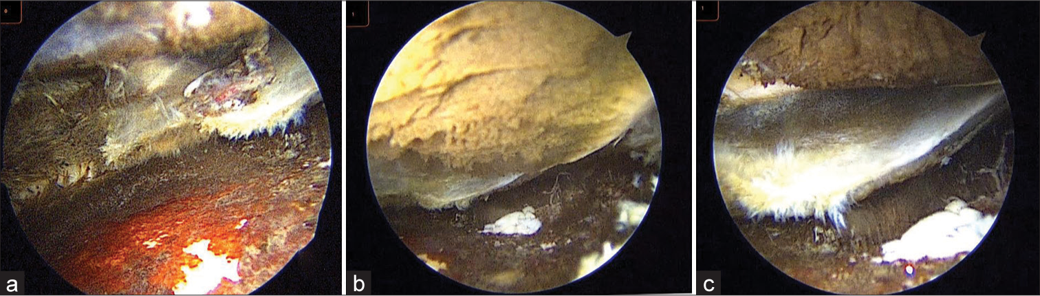 Arthroscopic image (a-c) of a knee joint showing (a) blackish-brown discoloration with degenerated lateral meniscus, (b) cartilage loss at femoral condyle, and (c) torn cartilage flap floating in the knee joint.