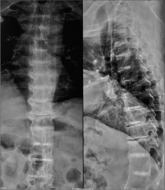 Radiograph of spine showing intervertebral joint calcification with degenerative changes.