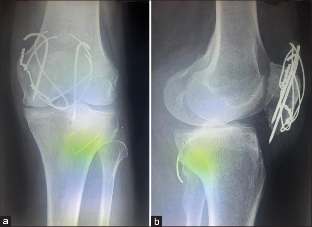 Broken and migrated wires of the tension band wire construct. (a) Anterior, posterior view showing missing wire at the superior border of the patella. (b) Lateral view showing the migrated wire in the posterior lateral aspect of the knee.