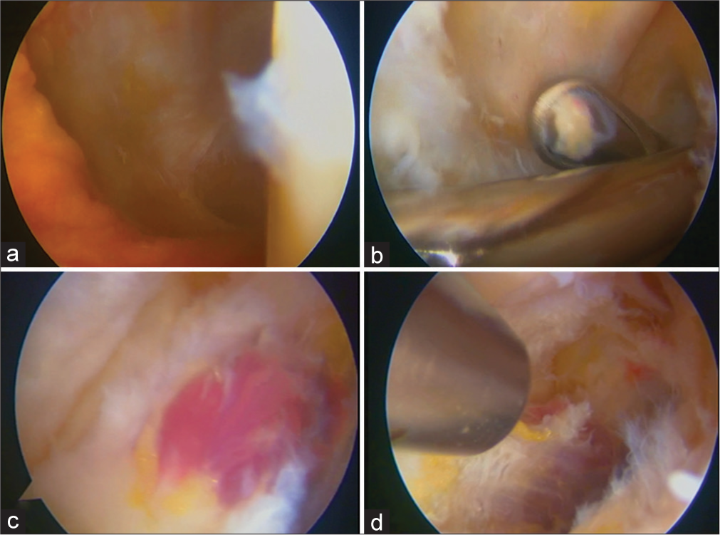 Diagnostic knee arthroscopy and portals. (a) The posterior lateral capsule showing rent. (b) Two posterior lateral portals were made for posterior knee arthroscopy. (c and d) View from the posterior lateral portal showing absent wires from the surface of the popliteus tendon.