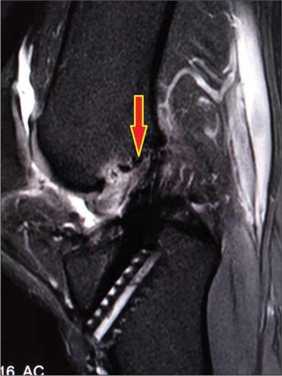 Magnetic resonance imaging: Sagittal section showing the inverted Cyclops (marked red arrow) arising in front of the anterior cruciate ligament graft.