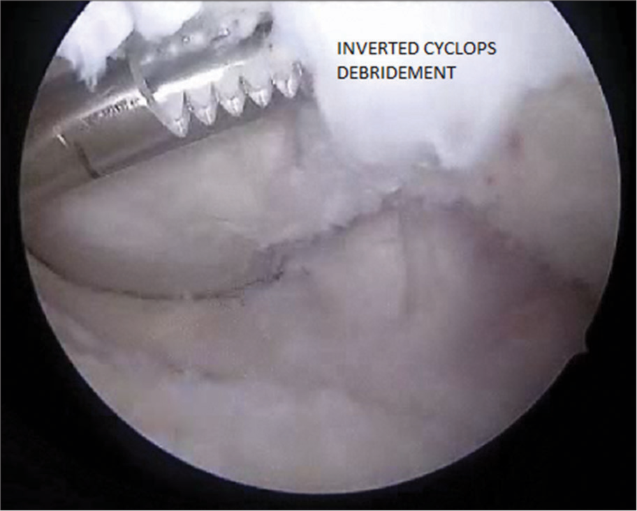 Debridement of inverted Cyclops with an arthroscopic shaver.