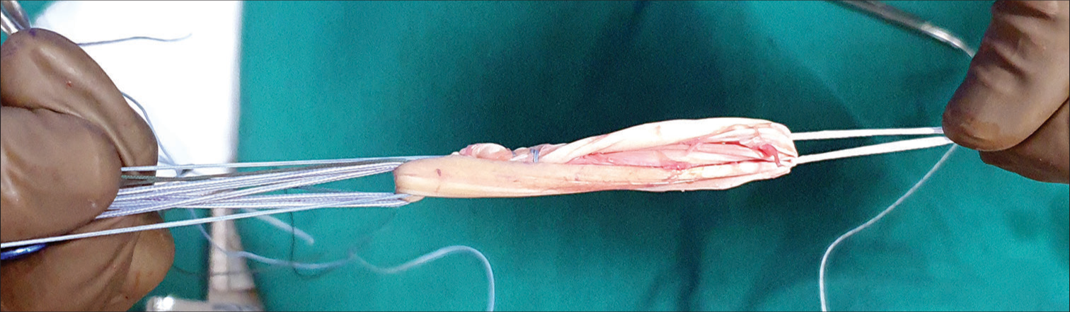 Docking of the whip-stitched end towards the suture disk over an adjustable femoral button to make a four or 8-strand graft.