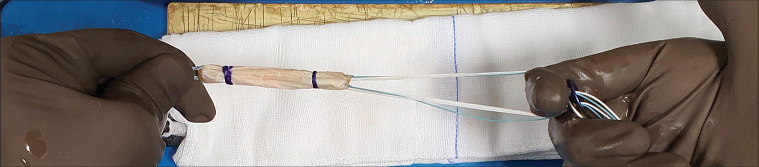 While inserting the graft tibial end to be held with a finger between the strands on each of the suture disk holes with a lightly clamped hemostat.