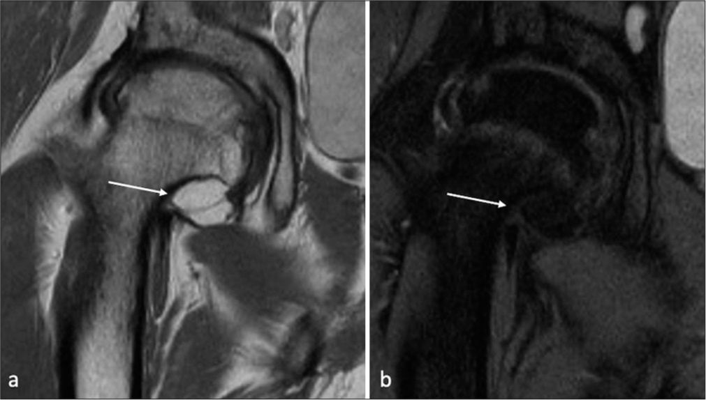 (a) Coronal T2 and (b) short-tau inversion recovery images show a centimetric intra-articular mass along the inferior margin of the femoral neck (white arrows).