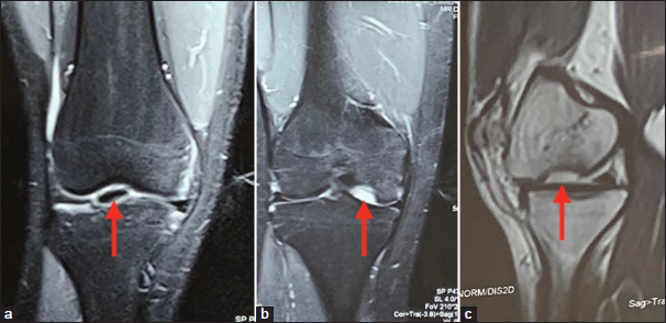 (a-c) Preoperative magnetic resonance images of a representative case with the red arrow indicating the osteochondral lesion.