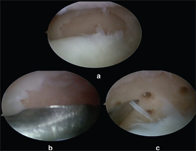 (a) Arthroscopic image of an osteochondral fragment of the medial femoral condyle seen separated from its bed, (b) arthroscopic image showing the bed of the fragment being curetted, and (c) arthroscopic image showing microfractures being done in the bed of the fragment on the medial femoral condyle.