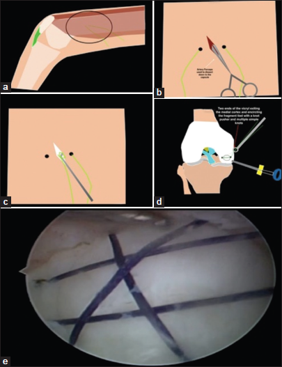 (a) Illustration of No. 1 Vicryl sutures exiting through the medial aspect of the thigh, (b) illustration showing a linear incision made between the two ends of the same suture, (c) illustration showing a probe delivering the two ends of the suture through the wound, (d) illustration showing a knot pusher tying two ends of the suture on the medial femoral cortex to stabilize the fragment, and (e) arthroscopic image showing the stabilized fragment with multiple No. 1 Vicryl sutures.