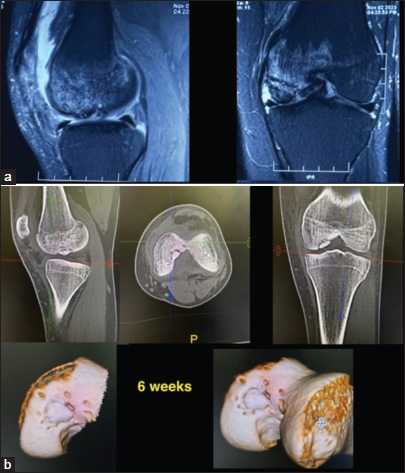 (a) Magnetic resonance images after 3 months showing the fragment has healed and (b) computed tomographic scan images after 3 months showing the fragment has healed.