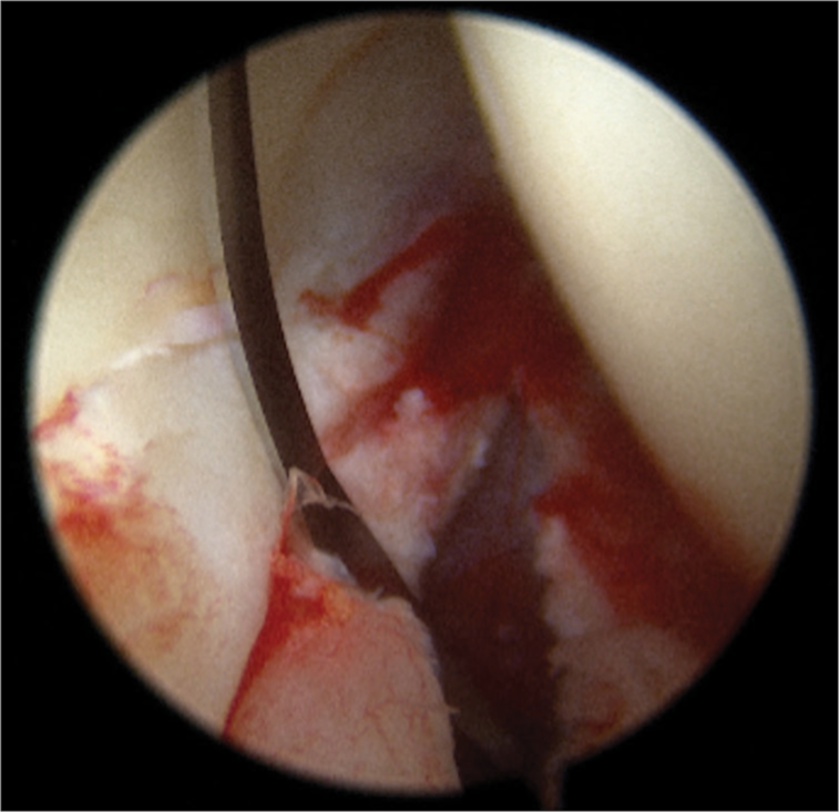 Hip synovitis during the creation of capsulotomy.