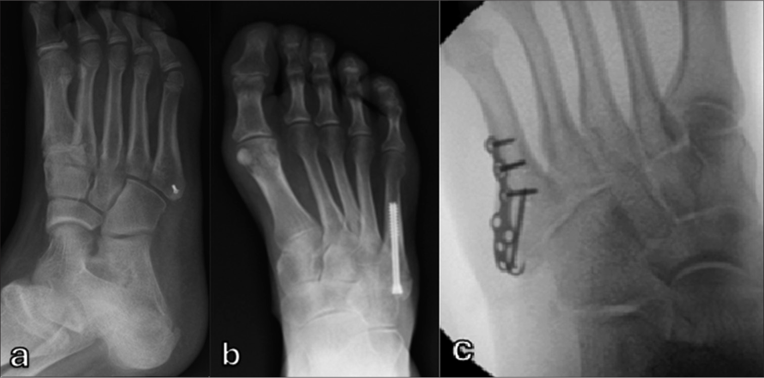 Radiographs showing fixation methods for tuberosity avulsion fracture. (a) Fragment excision and re-attachment of peroneus brevis tendon using bone anchor. (b) Intramedullary screw fixation. (c) Fixation with hook plate.