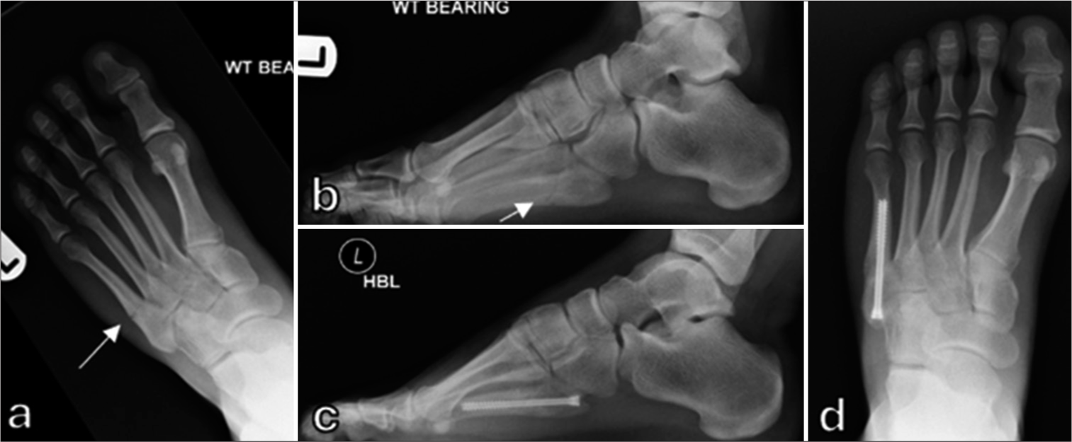 (a) Anteroposterior and (b) lateral radiographs of a 19-year-old professional footballer showing Jones-type fracture (white arrows). (c) Anteroposterior and (d) lateral radiographs 10 weeks later showing union following intramedullary screw fixation.