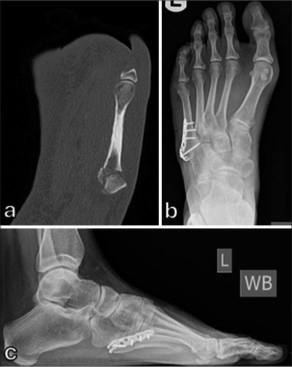 30-year-old female runner 8 weeks after injury. (a) Computed tomography scan showing comminuted tuberosity fracture. (b) Anteroposterior and (c) lateral radiographs following fixation with a hook plate.