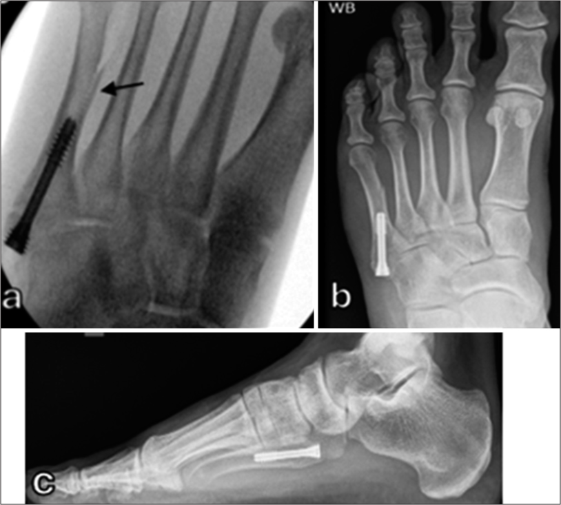 (a) Intraoperative radiograph showing iatrogenic fracture (black arrow) in the fifth metatarsal shaft following fixation with intramedullary screw. (b) Anteroposterior and (c) lateral radiographs showing both fractures united 3 months after surgery.