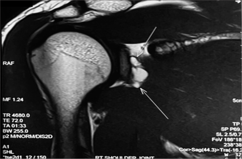 T1 weighted MRI saggital section with the white arrows showing paralabral cysts.