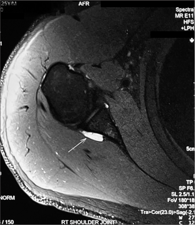 T2 weighted MRI axial section with the white arrow showing paralabral cysts near the postero-superior labrum.