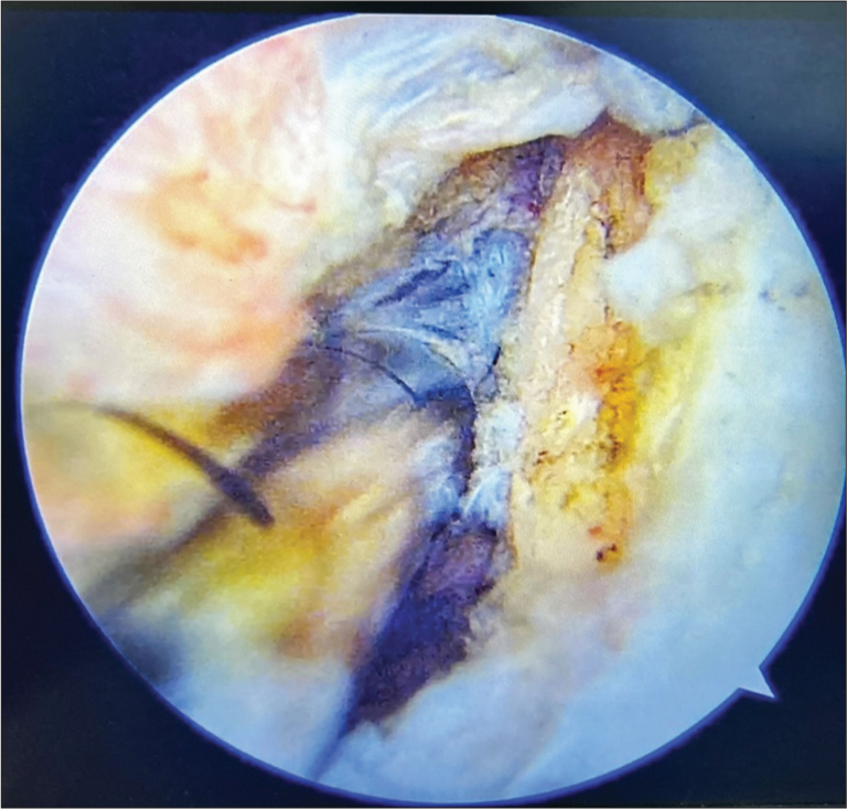 Image showing cyst decompression.