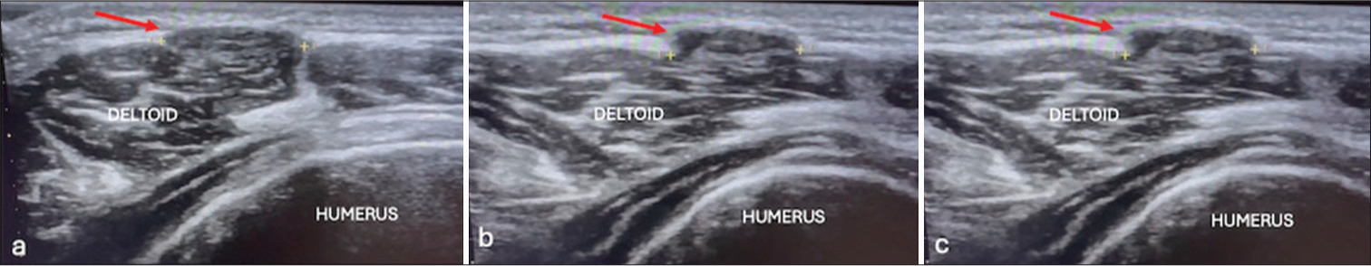 (a) Short axis ultrasound and (b and c) longitudinal ultrasound image showing herniation of deltoid muscle (red arrows).