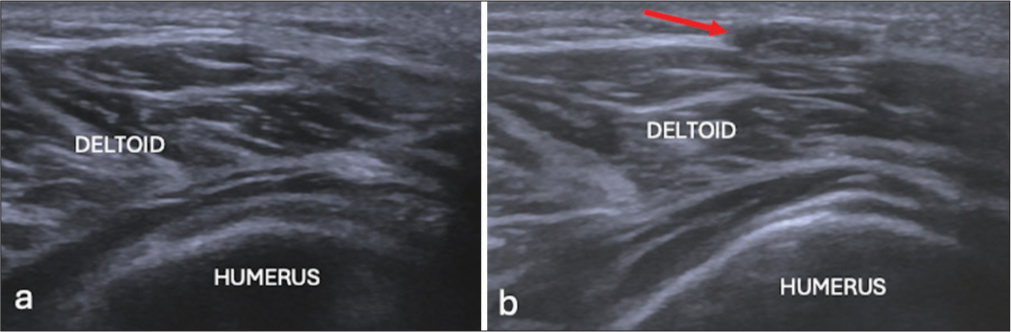 (a) Short axis ultrasound image and (b) on stressing showing herniation of deltoid through fascial defect (red arrow).