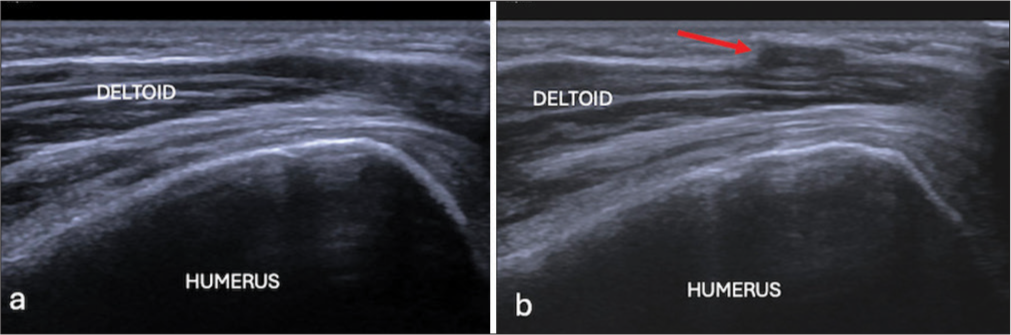 (a) Longitudinal ultrasound image and (b) on stressing showing herniation of deltoid through fascial defect (red arrow).