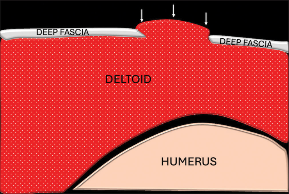 Schematic representation showing deltoid hernia (white arrows).