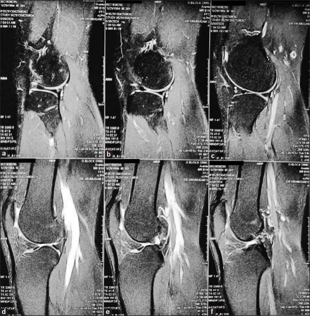 Pre-operative magnetic resonance imaging short tau inversion recovery and T2-weighted images sagittal section showing complete tear of the anterior cruciate ligament.